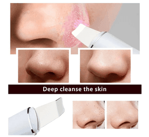 Espátula Peeling Ultrasónica Facial Exfoliante Iones Acné